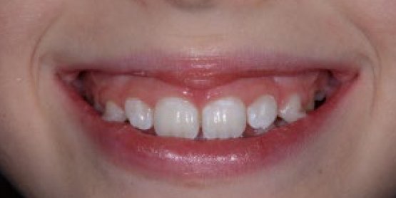 mixed dentition-2